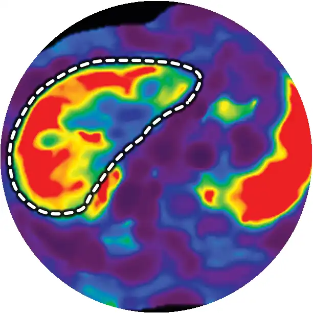 MRI Elastography